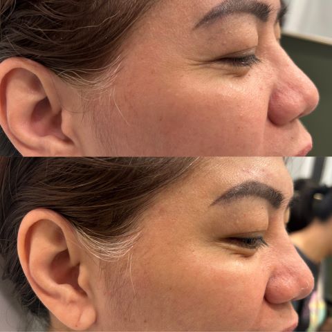 Botox for Crow's Feet